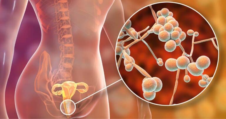An image illustrating Candida overgrowth in a woman's uterus explained from a functional medicine perspective.