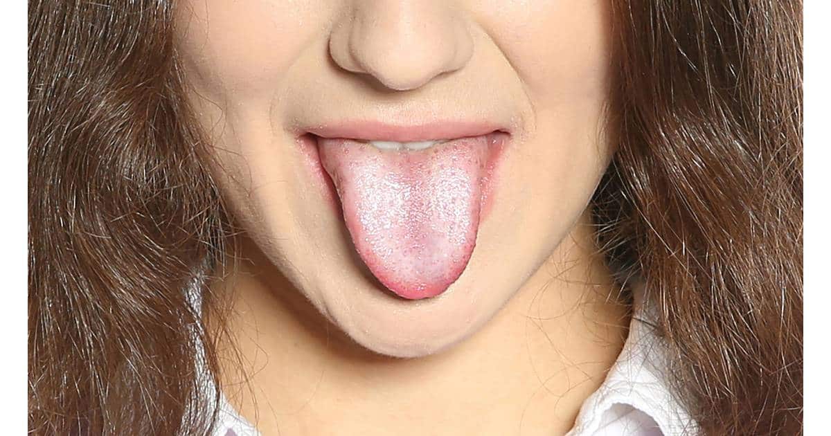 White tongue coating from candida or yeast